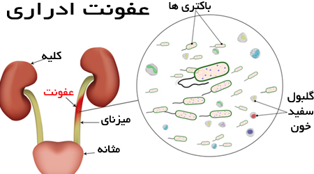 پیلونفریت