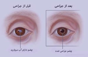 آب مروارید