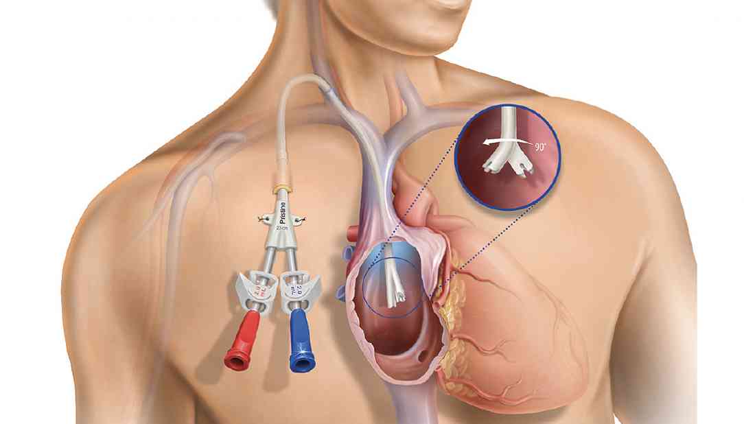 Dialysis catheter 1
