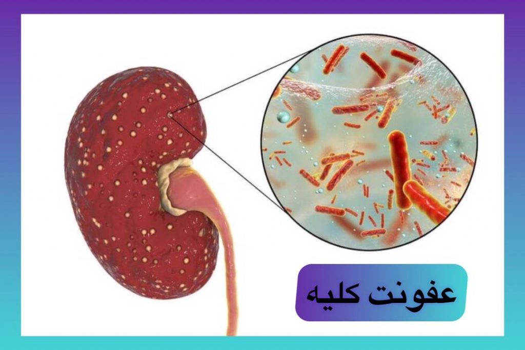 پیلونفریت
