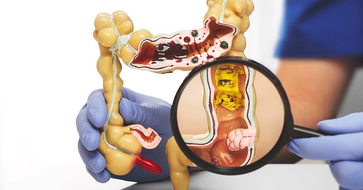 wollen lymph nodes