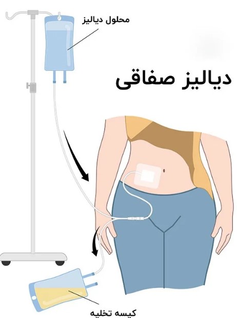 دیالیز صفاقی