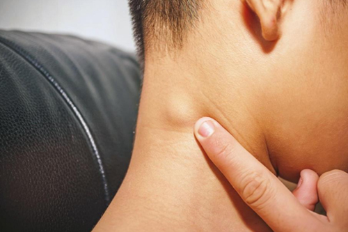 wollen lymph nodes