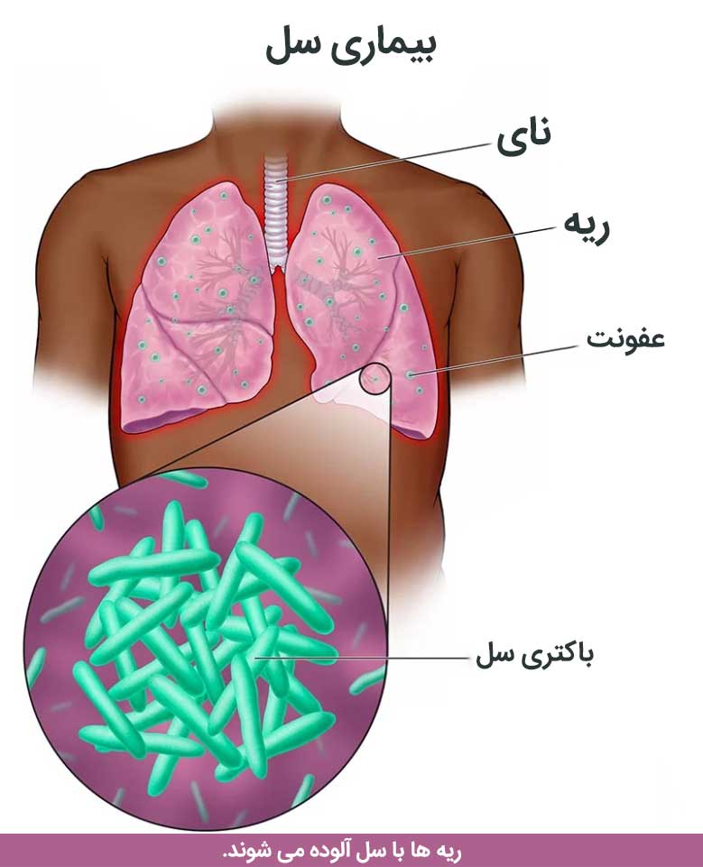 بیماری سل arminlab3