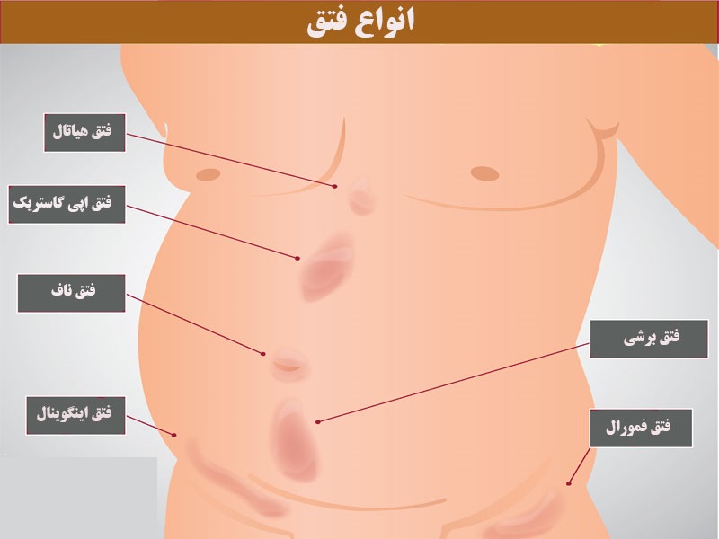 هرنی