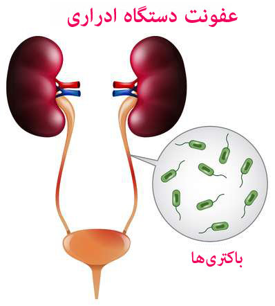 عفونت ادراری